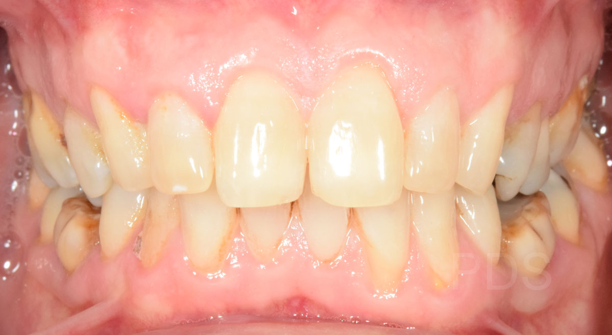 Case 1 Dental Crown Before