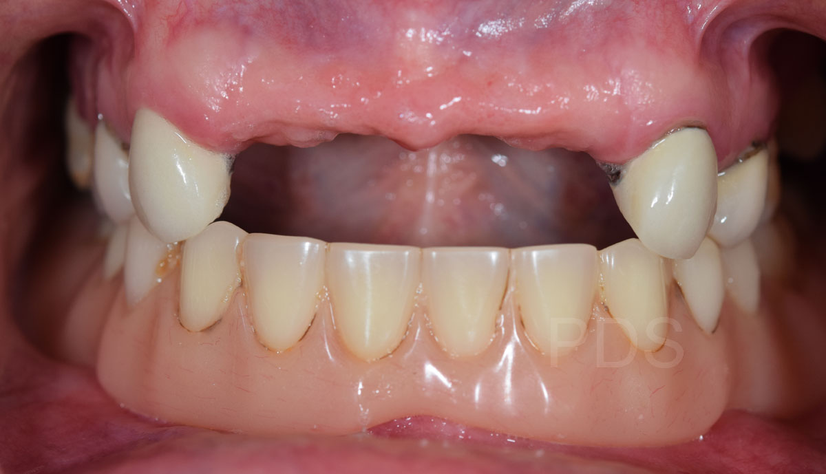 Case 5 Dentures Before