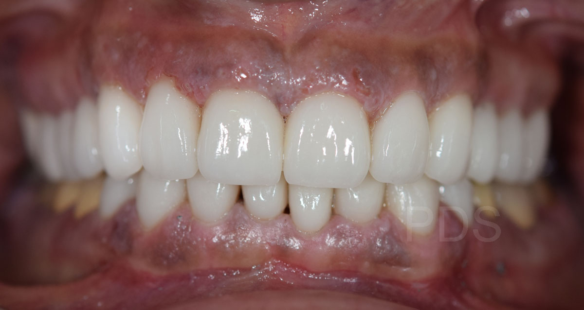 Case 2 Crowns After