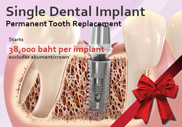 Phuket Dental Implant